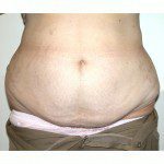 Abdominoplasty 29 Before Photo - 12