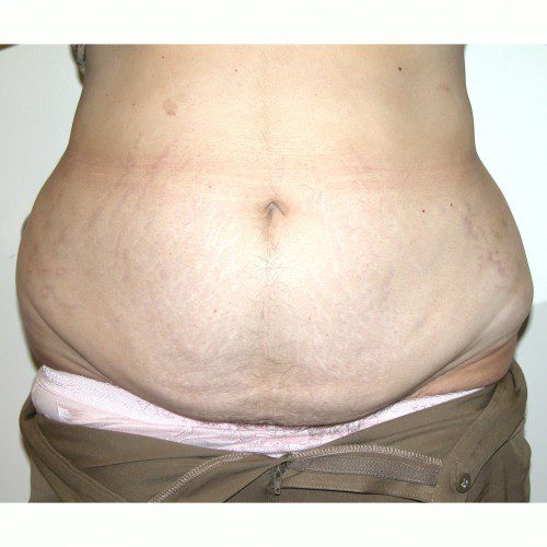 Abdominoplasty 29 Before Photo 