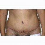 Abdominoplasty 30 After Photo - 11