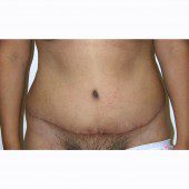 Abdominoplasty 30