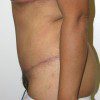 Abdominoplasty 30 After Photo Thumbnail