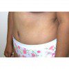 Abdominoplasty 30 After Photo Thumbnail