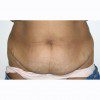 Abdominoplasty 30 Before Photo Thumbnail