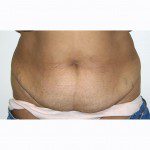 Abdominoplasty 30 Before Photo - 10