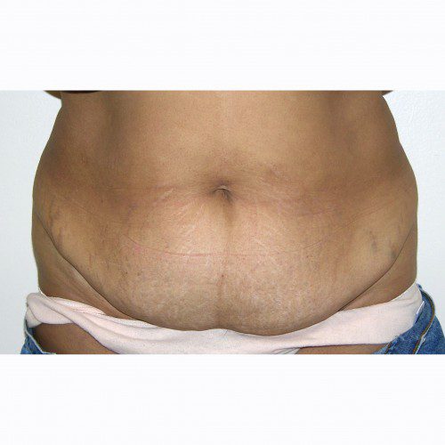 Abdominoplasty 30 Before Photo 