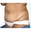 Abdominoplasty 30 Before Photo Thumbnail