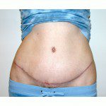 Abdominoplasty 31 After Photo - 9