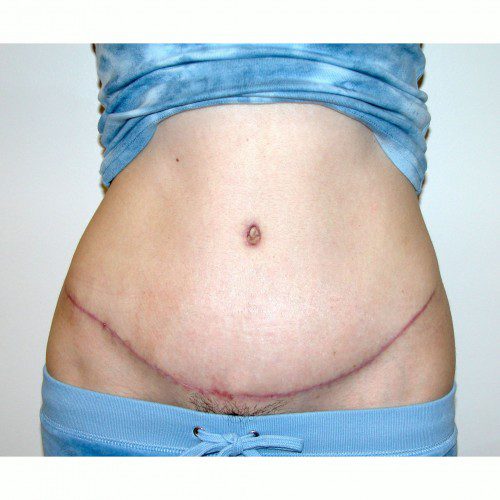 Abdominoplasty 31 After Photo 