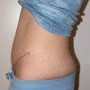 Abdominoplasty 31 After Photo Thumbnail