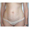 Abdominoplasty 31 Before Photo Thumbnail