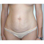 Abdominoplasty 31