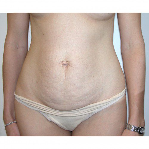 Abdominoplasty 31 Before Photo 