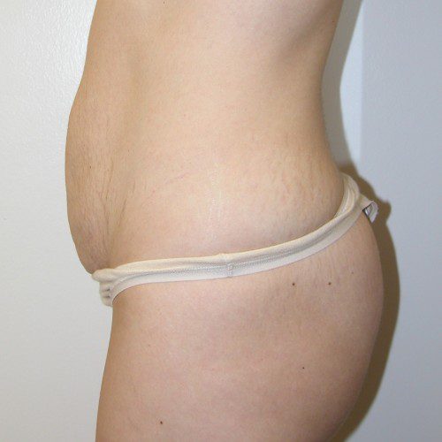 Abdominoplasty 31 Before Photo