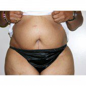 Abdominoplasty 32