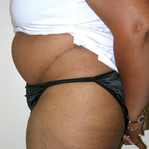 Abdominoplasty 32 After Photo