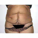 Abdominoplasty 32 Before Photo - 8