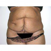 Abdominoplasty 32