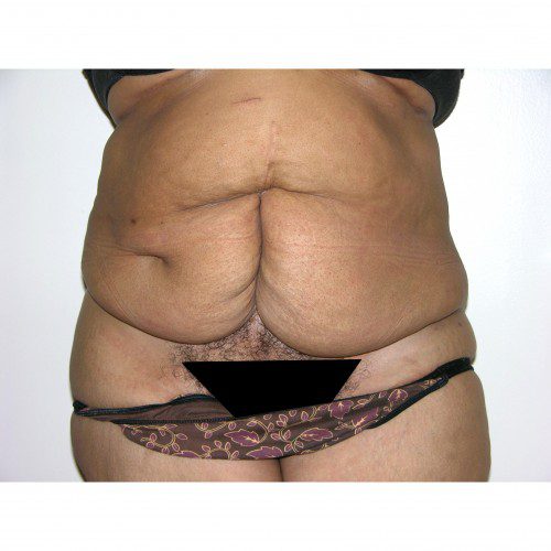 Abdominoplasty 32 Before Photo 