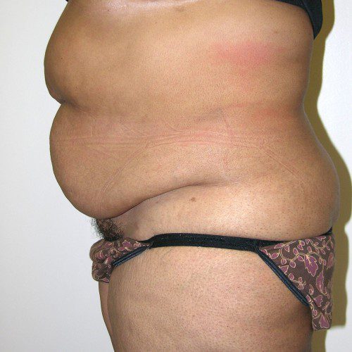 Abdominoplasty 32 Before Photo