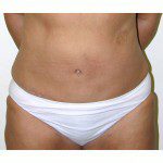 Abdominoplasty 33 After Photo - 7