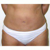 Abdominoplasty 33