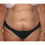 Abdominoplasty 33 Before Photo - 7