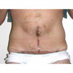 Abdominoplasty 34 After Photo - 7