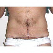 Abdominoplasty 34
