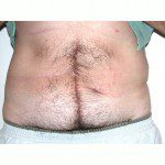 Abdominoplasty 34 Before Photo - 7