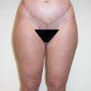 Abdominoplasty 35 After Photo Thumbnail