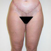Abdominoplasty 35