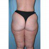 Abdominoplasty 35 Before Photo Thumbnail
