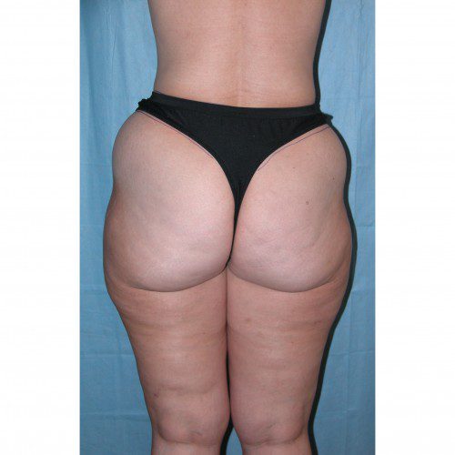 Abdominoplasty 35 Before Photo