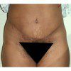 Abdominoplasty 36 After Photo Thumbnail