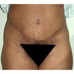 Abdominoplasty 36 After Photo - 5