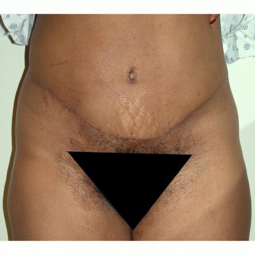 Abdominoplasty 36 After Photo 