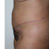 Abdominoplasty 36 After Photo Thumbnail