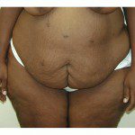 Abdominoplasty 36 Before Photo - 5