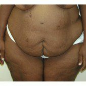 Abdominoplasty 36