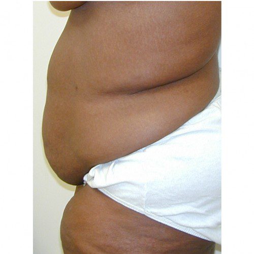 Abdominoplasty 36 Before Photo