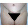Abdominoplasty 37 After Photo Thumbnail
