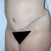 Abdominoplasty 37 After Photo Thumbnail