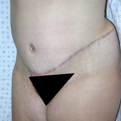 Abdominoplasty 37 After Photo