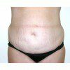 Abdominoplasty 37 Before Photo Thumbnail