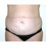 Abdominoplasty 37 Before Photo - 4