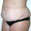 Abdominoplasty 37 Before Photo Thumbnail