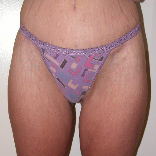 Abdominoplasty 8 After Photo 