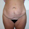 Abdominoplasty 8 Before Photo Thumbnail