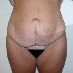 Abdominoplasty 8 Before Photo - 10