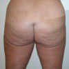 Abdominoplasty 8 Before Photo Thumbnail